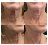 Restorative Neck Complex
