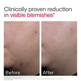 EltaMD UV Clear Blemish-Prone & Oil Balancing SPF 50