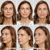 Sculptra | Save $150